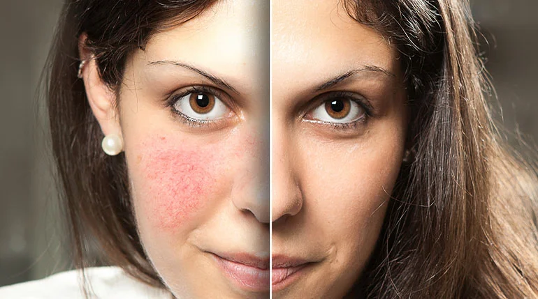 Cera naczynkowa kobiety z czerwonymi policzkami