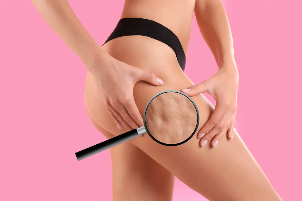 cellulit jak go zwalczyć